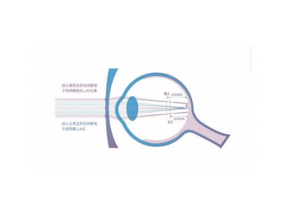 德国近视赛维离焦镜作用,赛维离焦镜